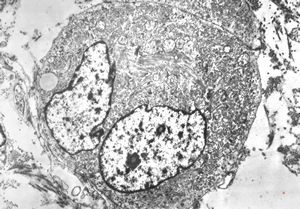 M,29y. | embryonal rhabdomyosyrcoma in testicular teratoma M,29y. | embryonal rhabdomyosyrcoma in testicular teratoma
